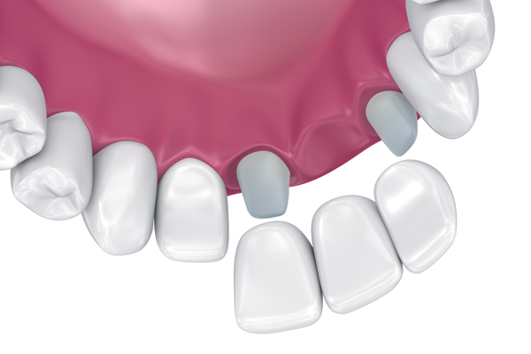 Tooth Replacement    : Why A Dentist May Recommend A Dental Bridge
