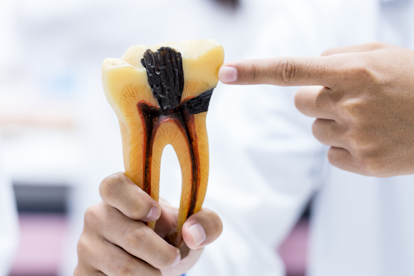 Pain And Root Canals: What You Should Know